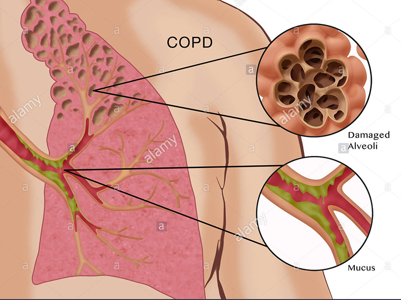 بیماری COPD یا انسدادی ریه و راه های پیشگیری و درمان!